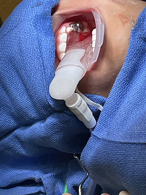 6-year-old patient during dental surgery with Zyris ORA in use.