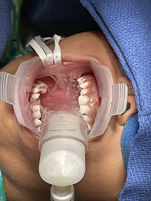 ORA providing suction and retraction during dental surgery on a 6-year-old patient.